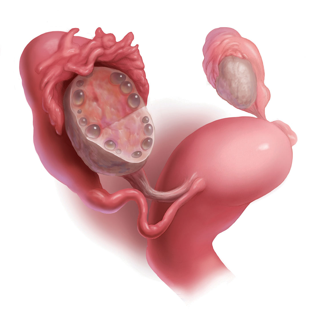Polycystic Ovary Syndrome Treatment Market-01e65a7d