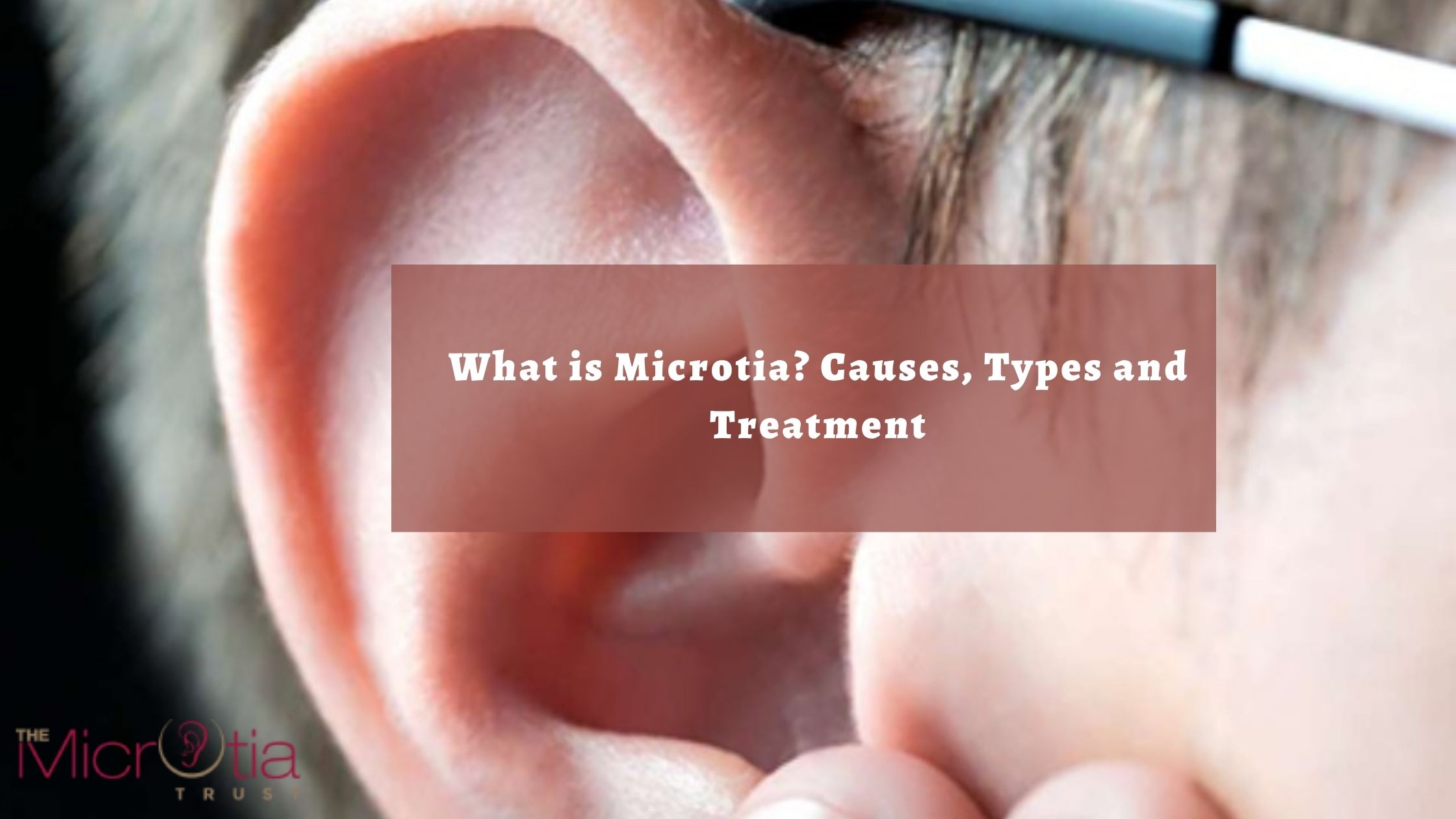 What is Microtia Causes, Types and Treatment-317c4904