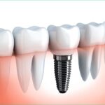 dental-implants-west-village-dental-toronto-dentist-dd7da772