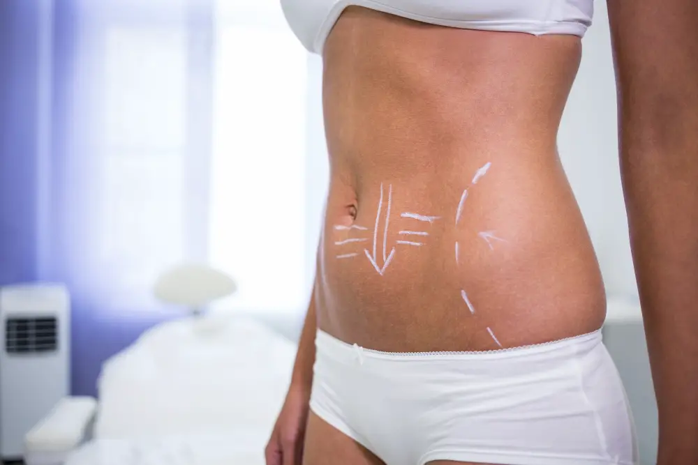 female-body-with-drawing-arrows-abdomen-liposuction-cellulite-removal (1)-285ed545