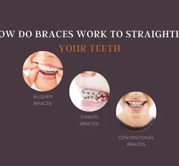 How Do Braces Work to Straighten Your Teeth-f6754344