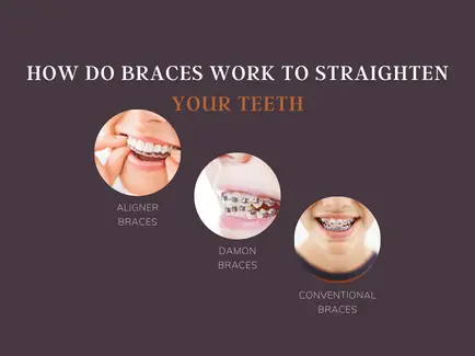 How Do Braces Work to Straighten Your Teeth-f6754344