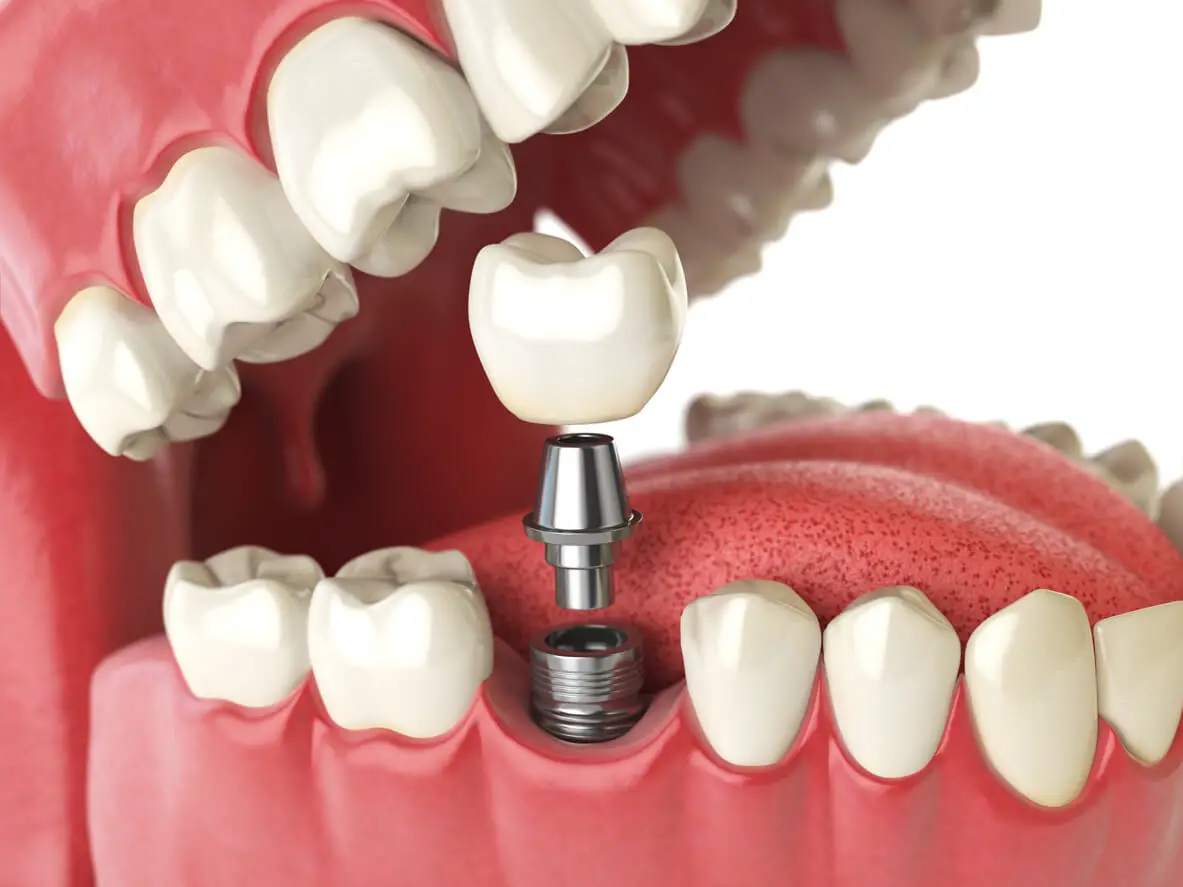 How to Prepare For a Mini Dental Implant-cf07b23b