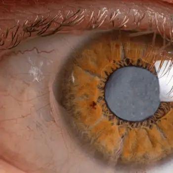 Cataract Eye