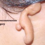 A guide to ear reconstruction surgery-493ed1a3
