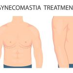 Gynecomastia Surgery in mumbai-bf5c7b78