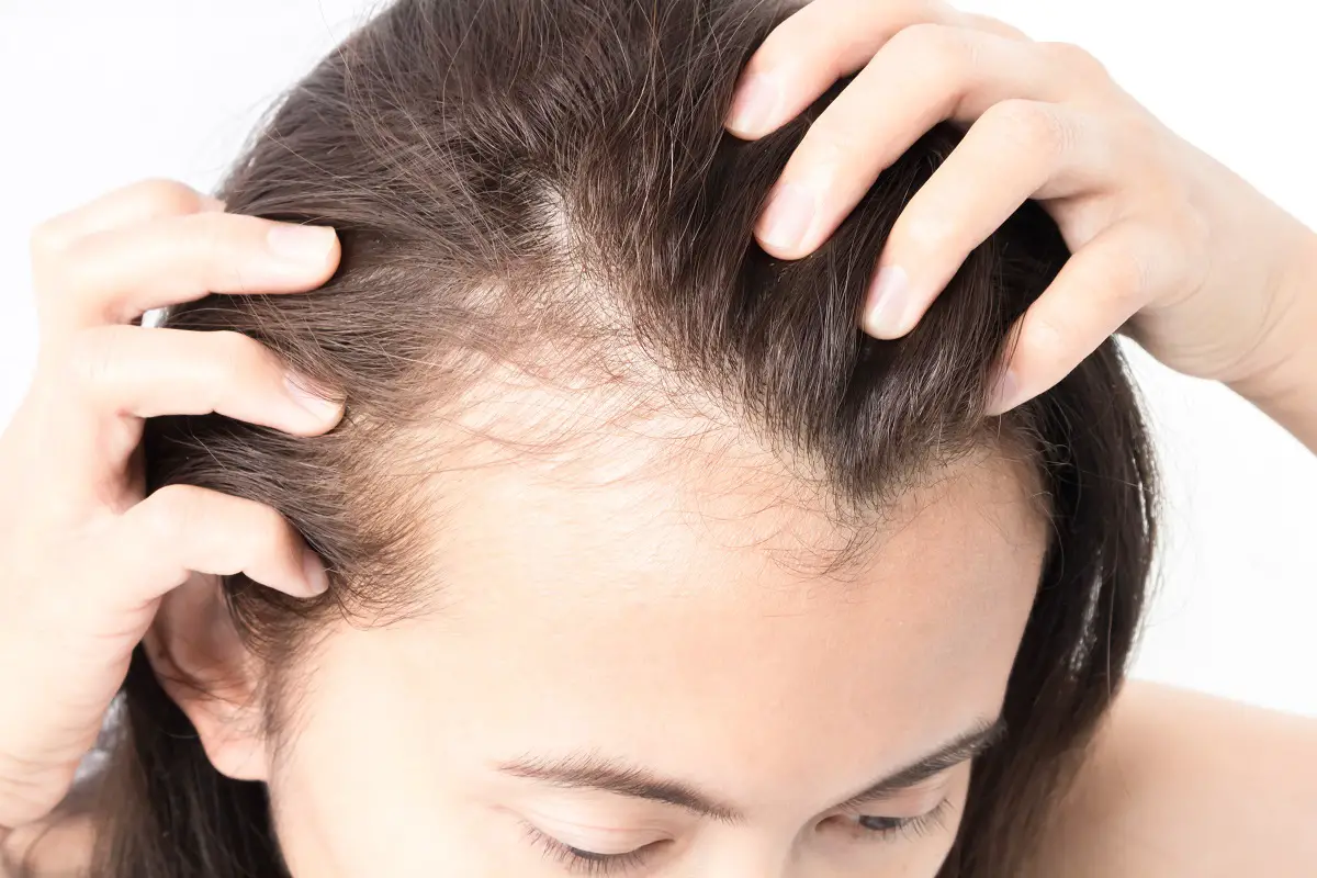 Hair Loss Treatment Market-55871336