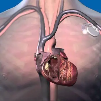 Implantable Cardiac Pacemaker Market-ed5070e9