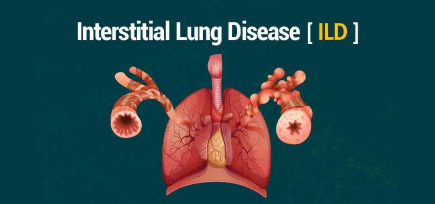 Interstitial Lung Disease Market-fe79d84a