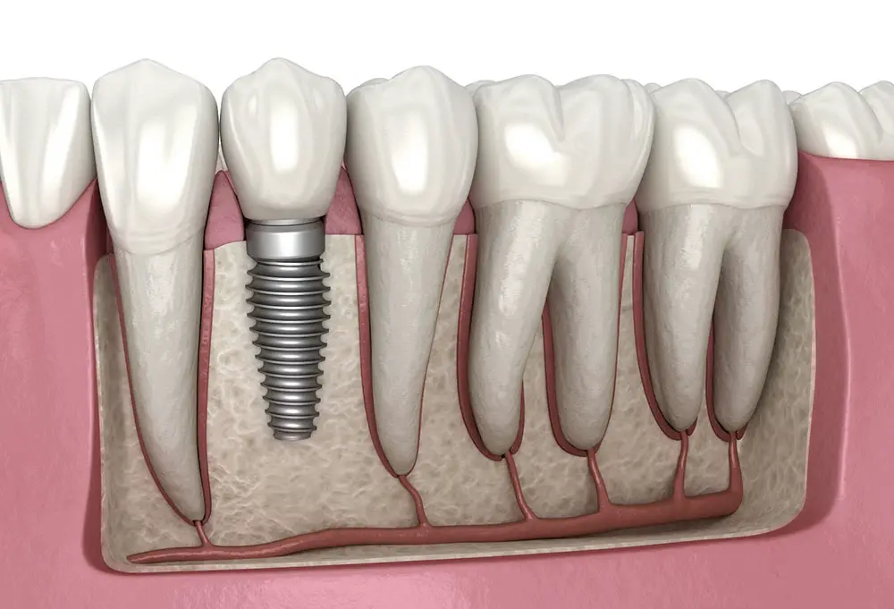 United States Dental Implants Market-f72ad404