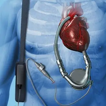 Ventricular Assist Devices Market-588777a6