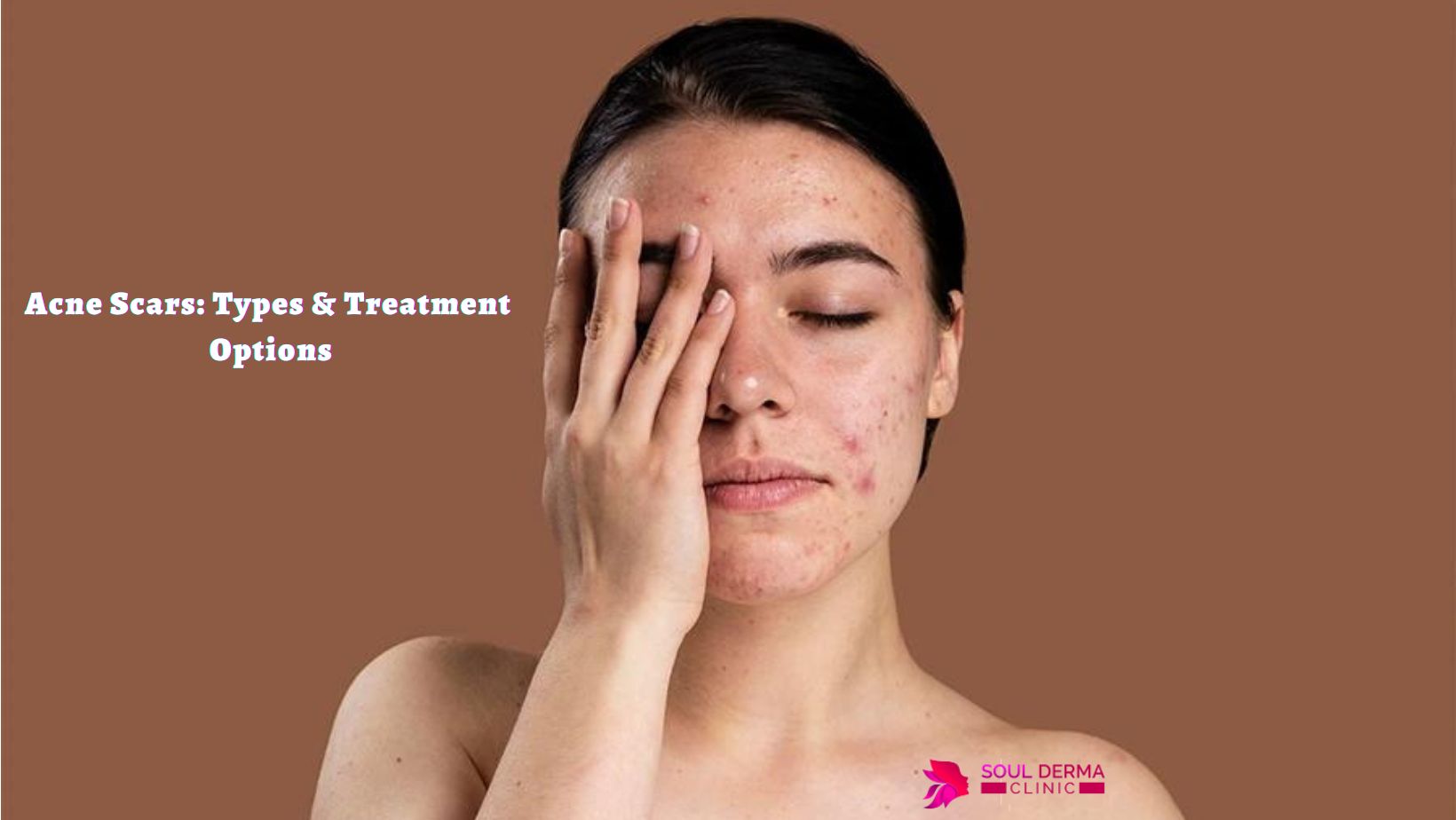 Acne Scars Types & Treatment Options