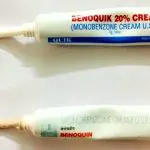 Benoquin Cream For Vitiligo Treatment