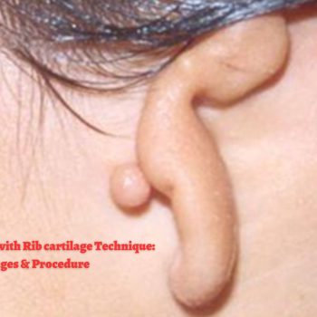 Ear Reconstruction with Rib cartilage Technique Advantages & Procedure