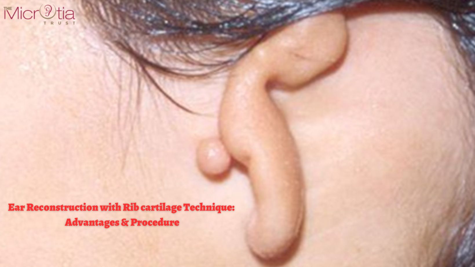Ear Reconstruction with Rib cartilage Technique Advantages & Procedure