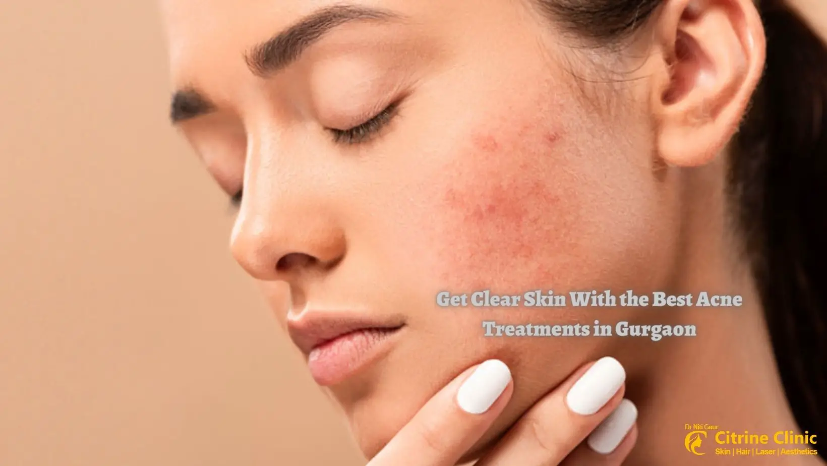 Get Clear Skin With Best Acne Treatments in Gurgaon