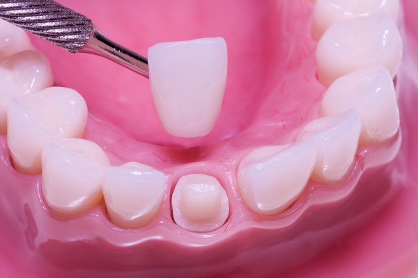 How porcelain crowns are effective if you have decayed or cavities in your teeth in the world of dentistry