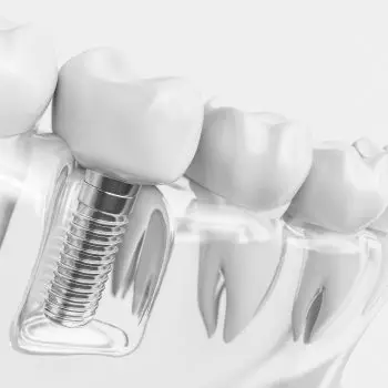 The Role of an Implant Dentist in Fairhope, AL Why You Should Consider Dental Implants