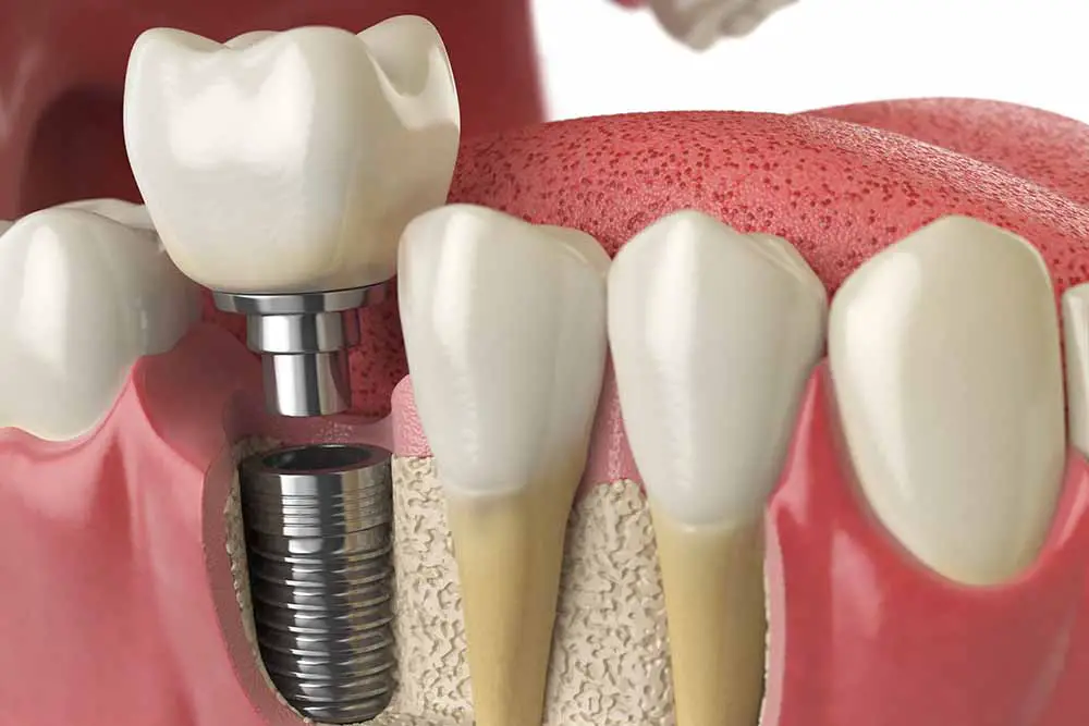 Why dental implants cost more than other dentistry treatments