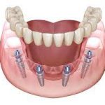 brisbbrisbane dentalanehttps://www.nextsmile.com.au/brisbane/ dental 9