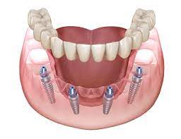 brisbbrisbane dentalanehttps://www.nextsmile.com.au/brisbane/ dental 9