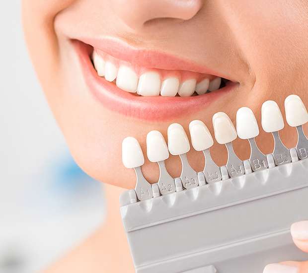 dental-veneers-and-dental-laminates-header