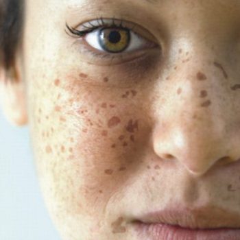 skin-vitiligo