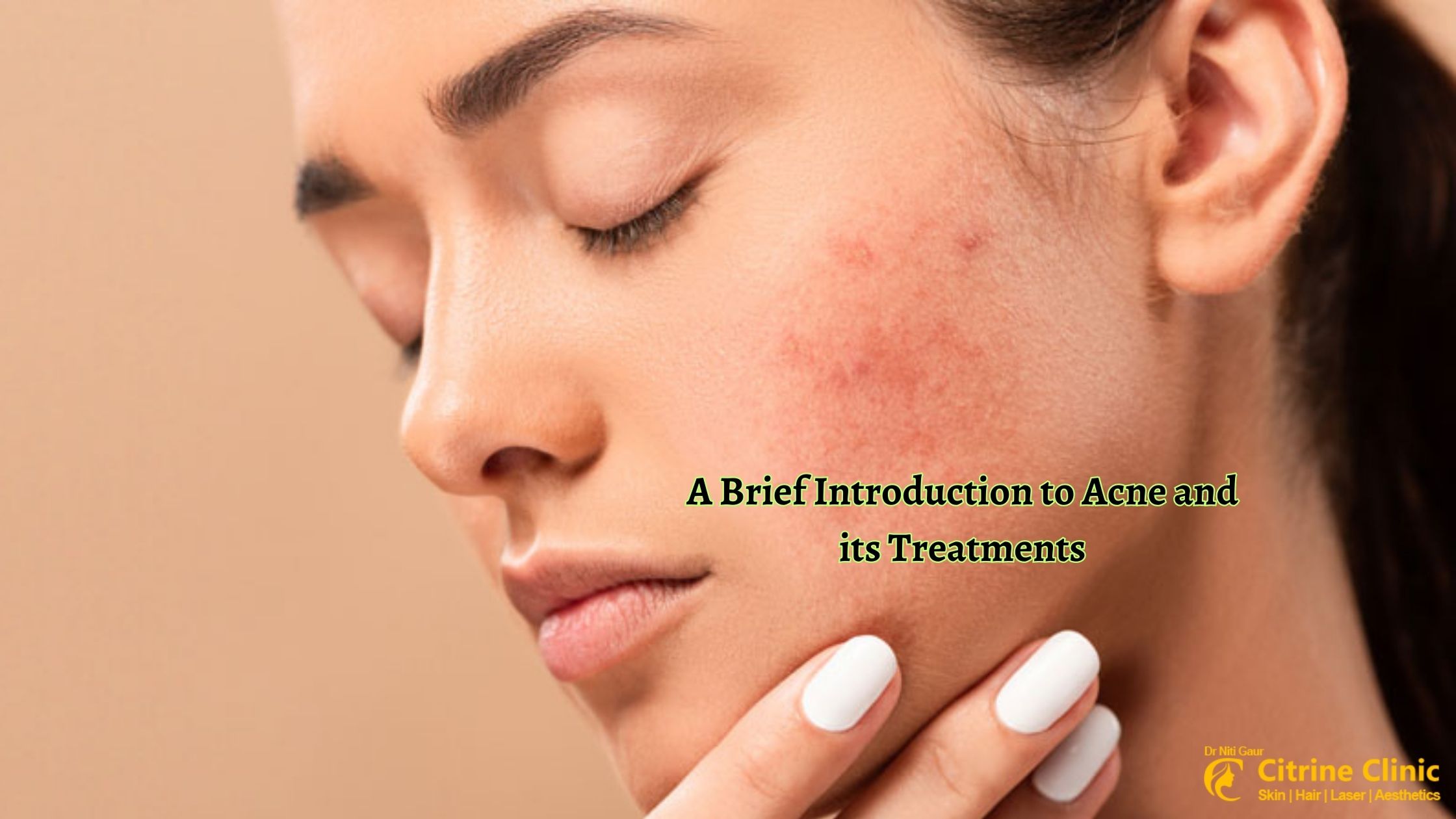 A Brief Introduction to Acne and its Treatments