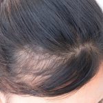 Androgenetic Alopecia Treatment Market