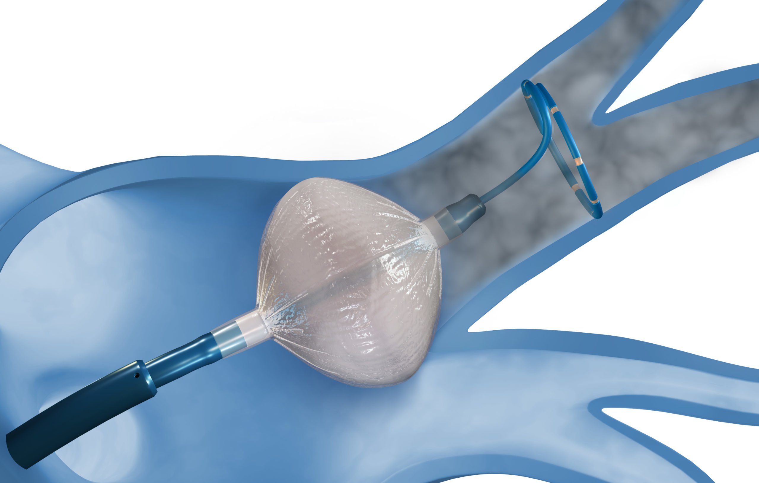 Cryoablation Devices Market