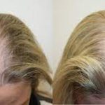 Laser Hair Growth Treatment