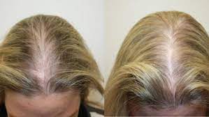 Laser Hair Growth Treatment