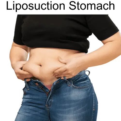 Liposuction Stomach