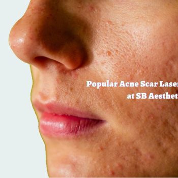 Popular Acne Scar Laser Treatments at SB Aesthetics