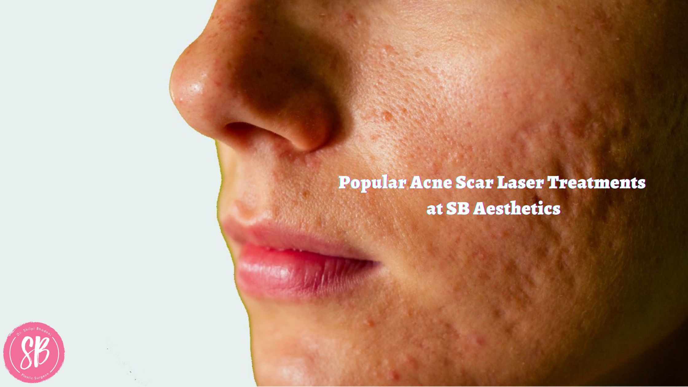 Popular Acne Scar Laser Treatments at SB Aesthetics