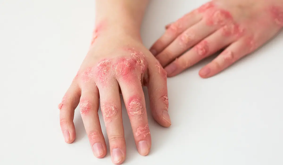 Psoriasis