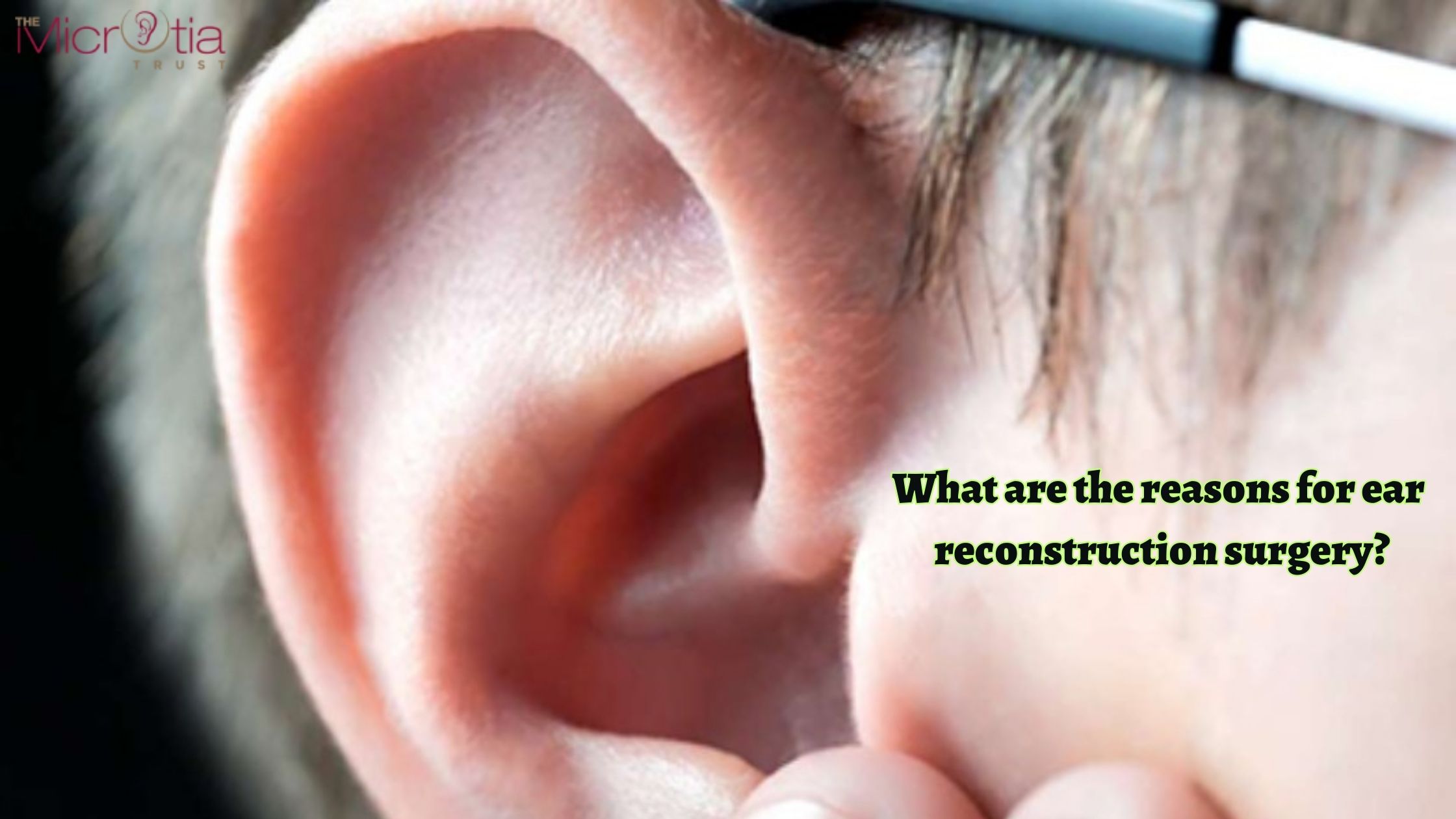 What are the reasons for ear reconstruction surgery