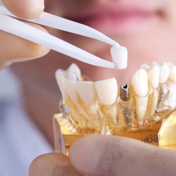 cost of dental implants st. petersburg fl