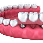 dental implants nashville