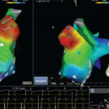 3D-Mapping-Images-For-Heart-Procedure-dr-siddhant-jain