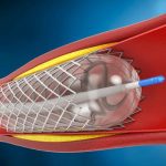 Angioplasty Balloons Market Size