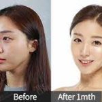 Best Korean Plastic Surgery Clinic
