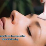 Chemical Peels Treatment for Skin Whitening