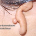 Deformed Ear Correction at the Microtia Trust