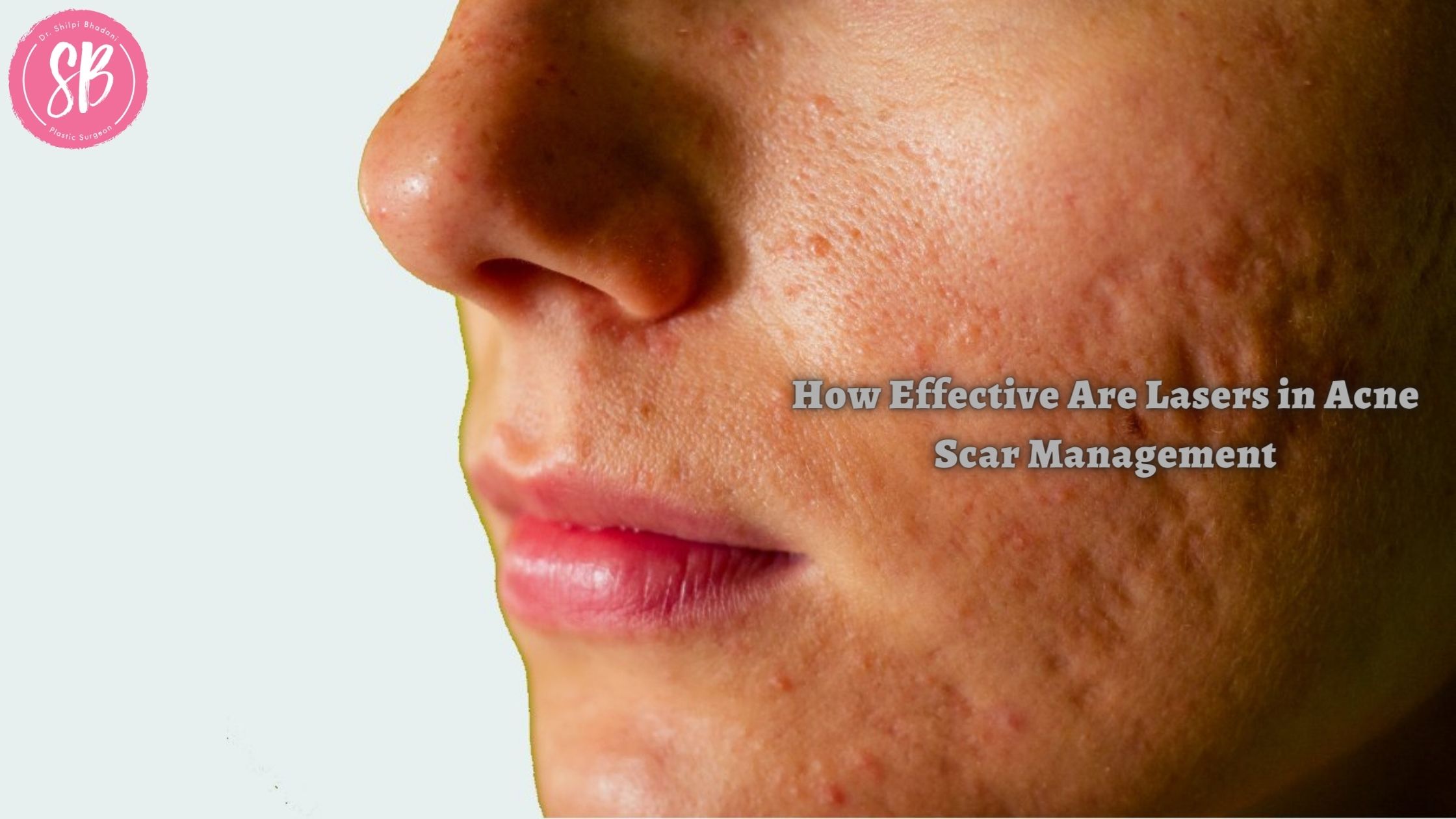 How Effective Are Lasers In Acne Scar Management