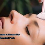 Skin Issues Addressed by Chemical Peels