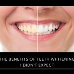 The Benefits Of Teeth Whitening I Didn't Expect