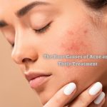 The Root Causes of Acne and Their Treatment