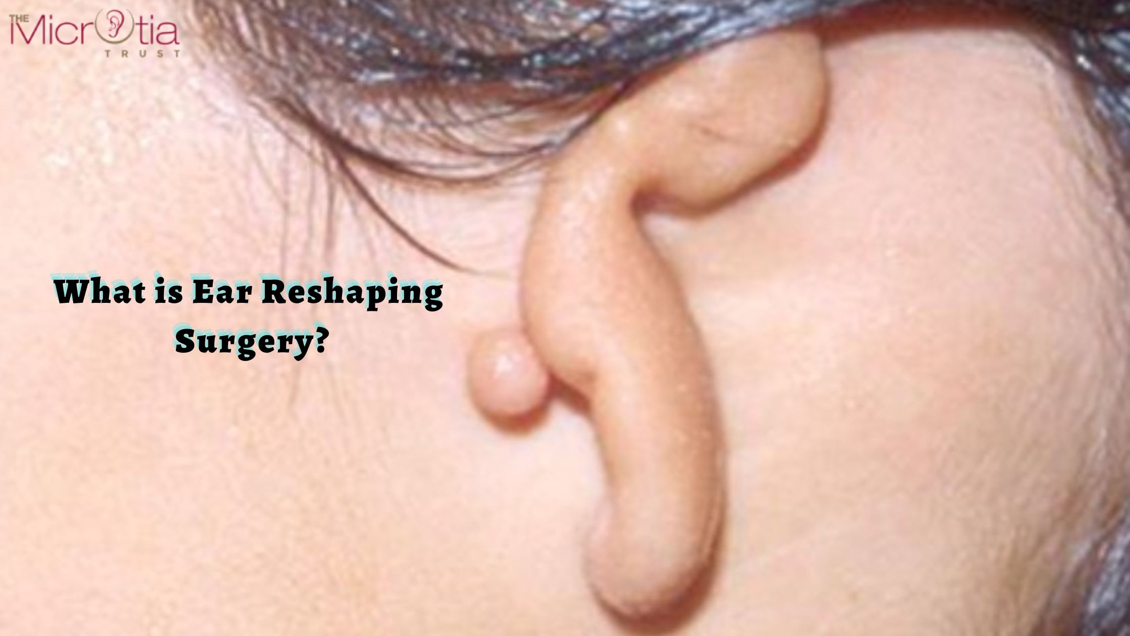 What is Ear Reshaping Surgery
