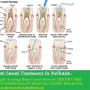 root-canal-treatment-in-kolkata1